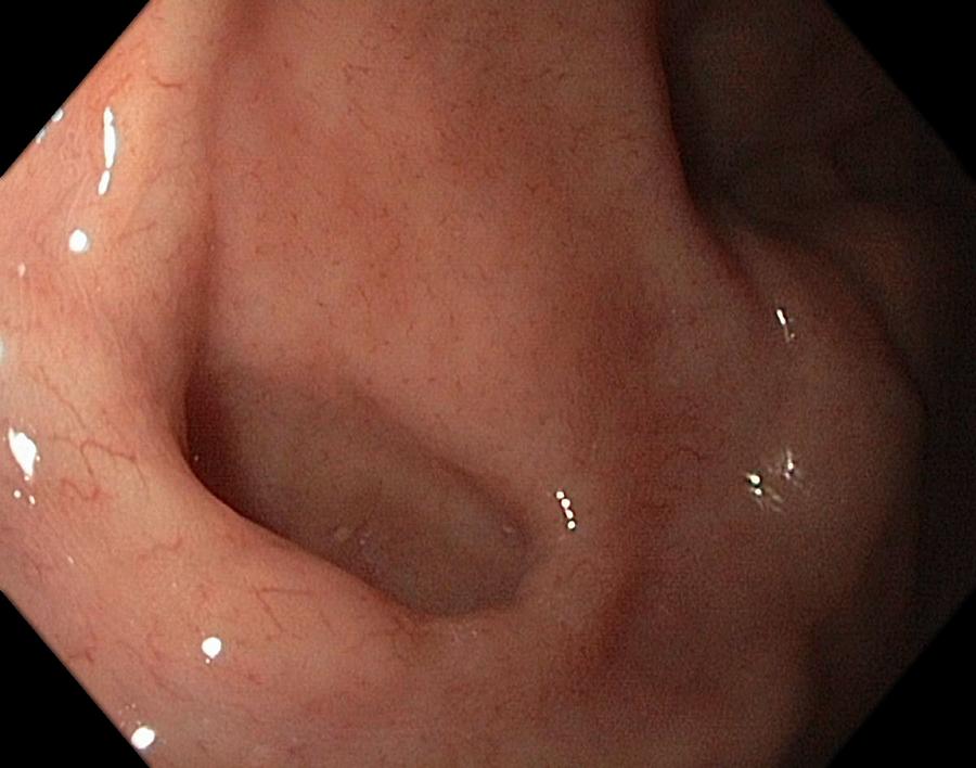 Endoscopy Photograph - Diverticulum In The Stomach by Gastrolab