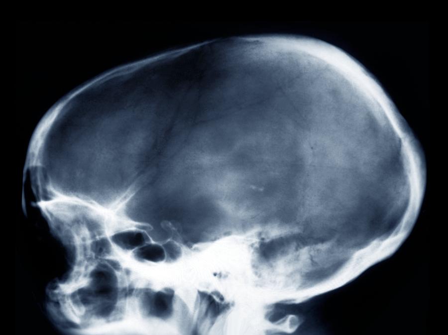 Dolichocephalic Skull Deformity, X-ray Photograph by Zephyr