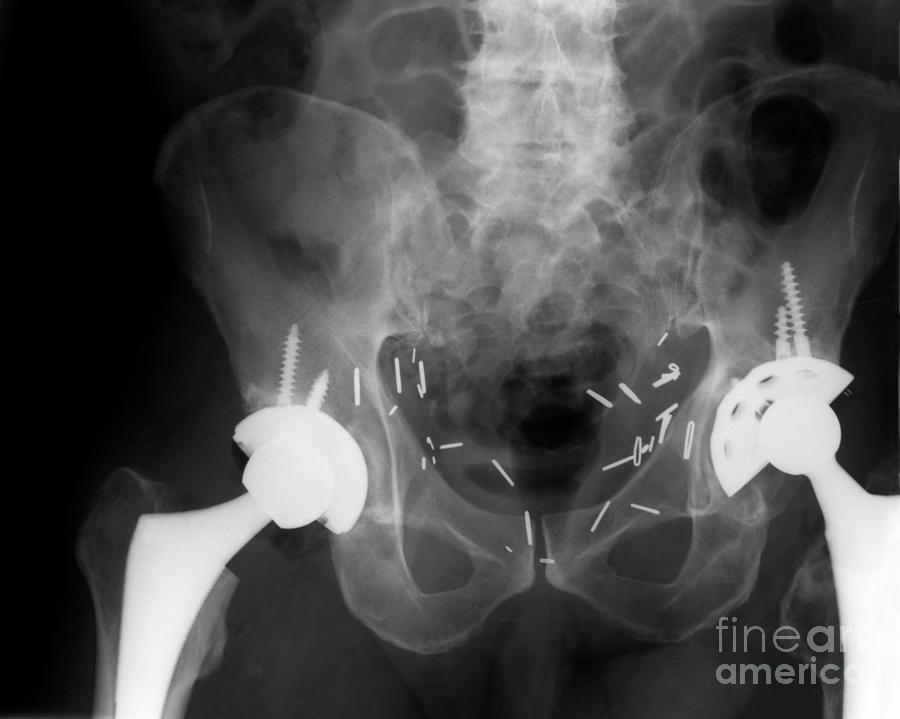 Double Hip Replacement Photograph by Ted Kinsman