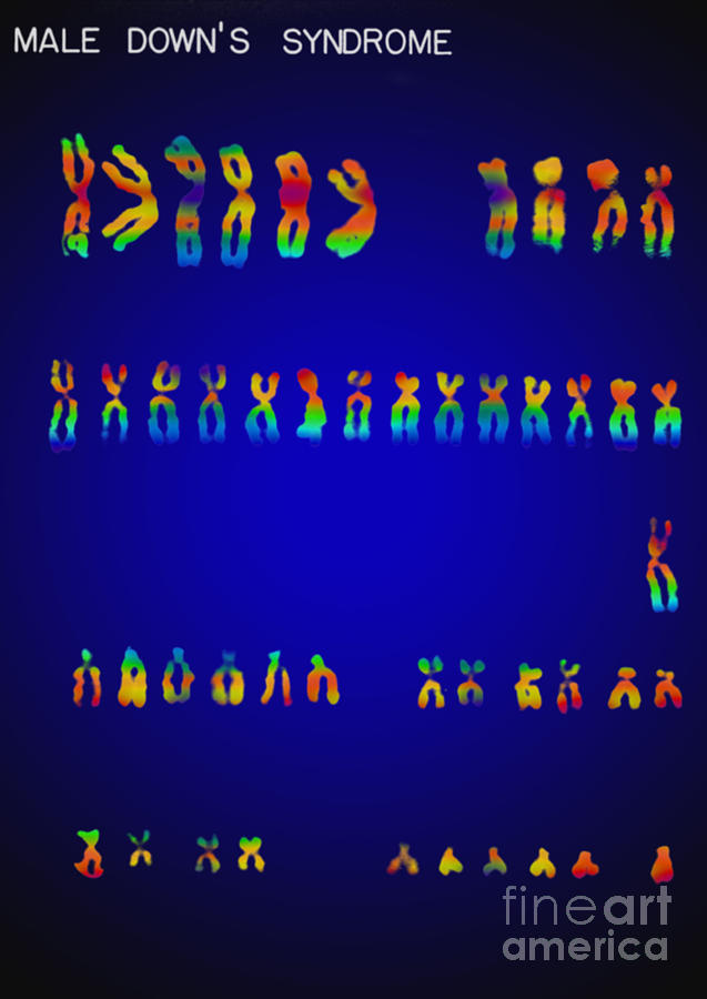 Downs Syndrome Karyotype Photograph by Omikron