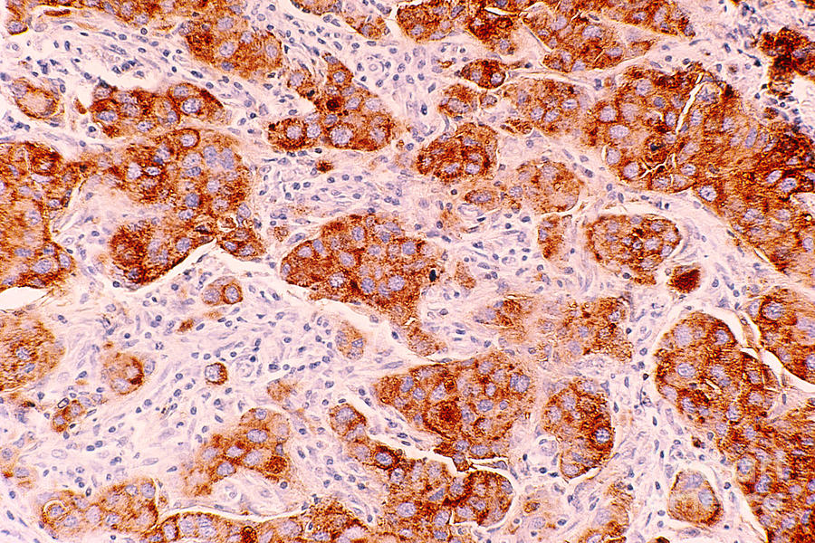 Ductal Carcinoma Of Human Breast Photograph by Science Source