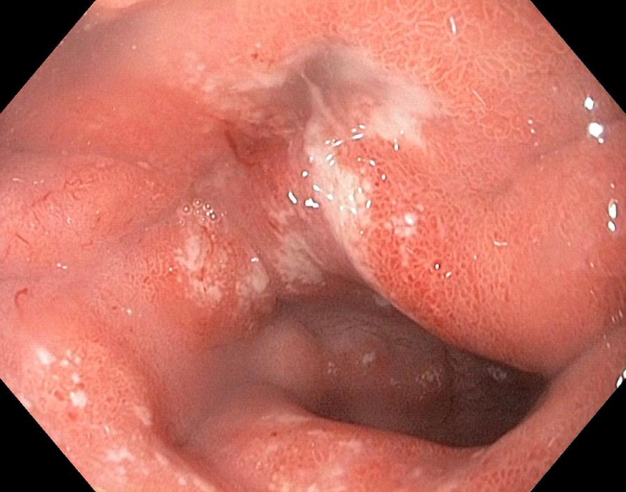 Endoscopy Photograph - Duodenal Ulcer by Gastrolab