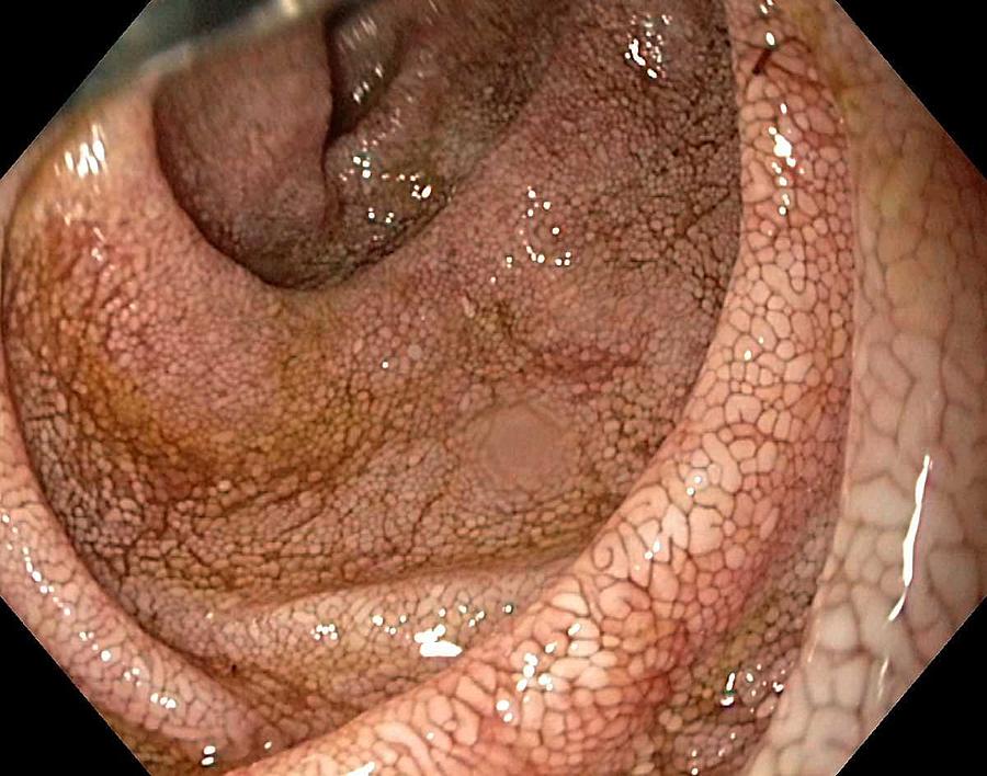 Endoscopy Photograph - Duodenum In Whipples Disease by Gastrolab