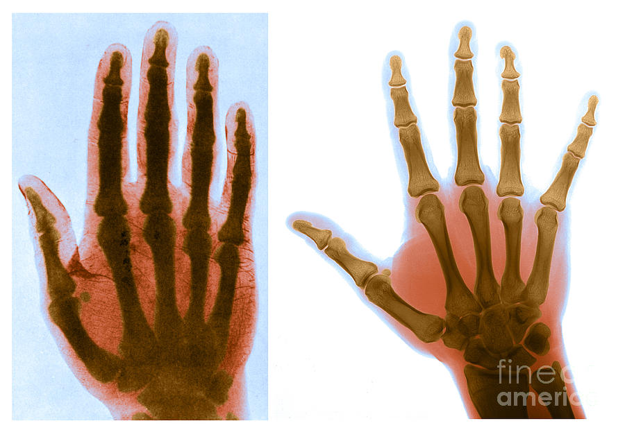 Early And Modern Hand X-rays Photograph by Medical Body Scans
