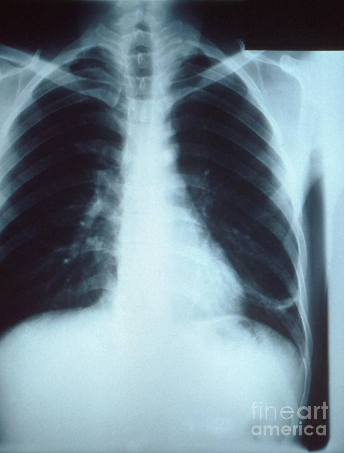 Science Photograph - Early Lower Left Lobe Pneumonia by Science Source