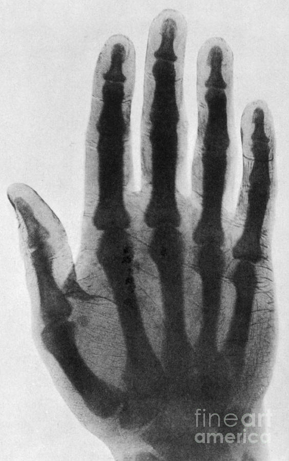 Early X-ray Photograph by Science Source
