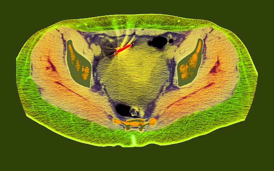 Ectopic Iud Contraceptive, Ct Scan Photograph by Du Cane Medical ...