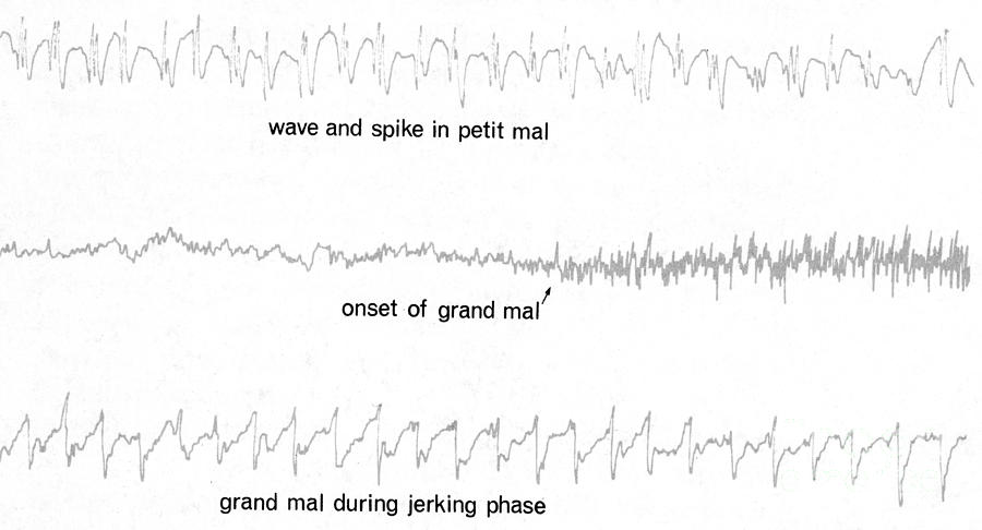 Eeg Of Epileptic Seizures Photograph by Science Source