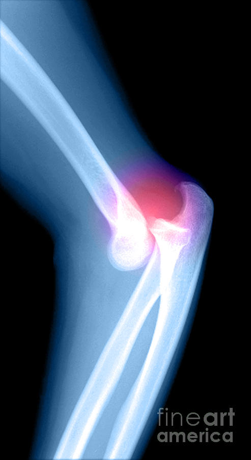 Elbow Injury Photograph by Medical Body Scans