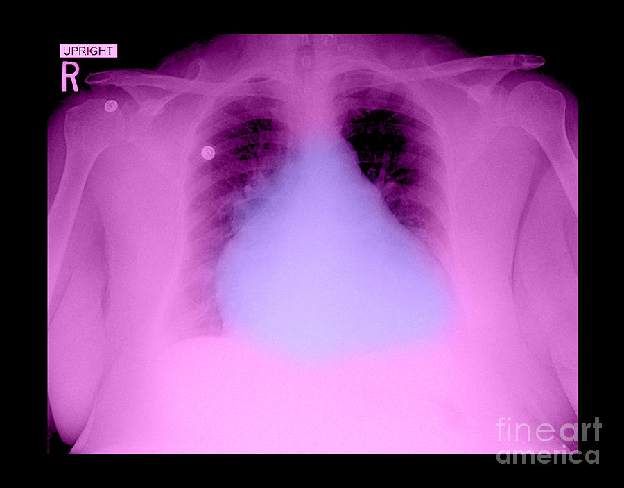Enlarged Heart On Chest X Ray Photograph By Medical Body Scans
