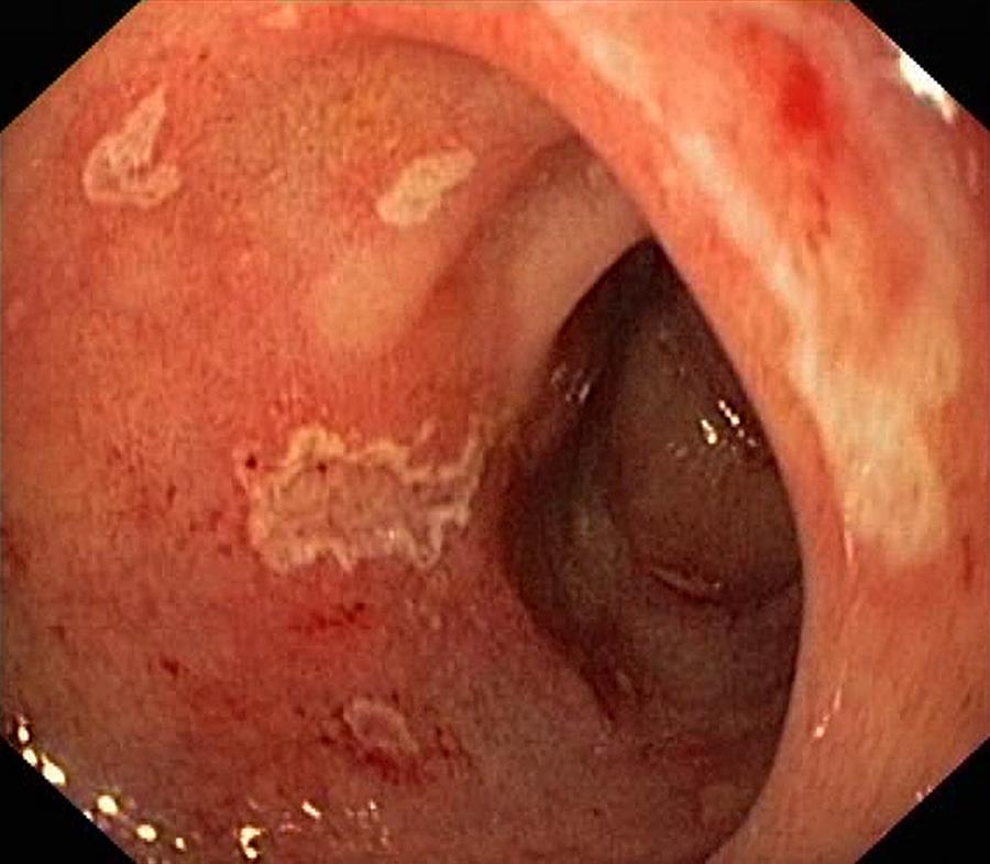Endoscope Photograph - Erosive Duodenitis, Endoscopic View by Gastrolab