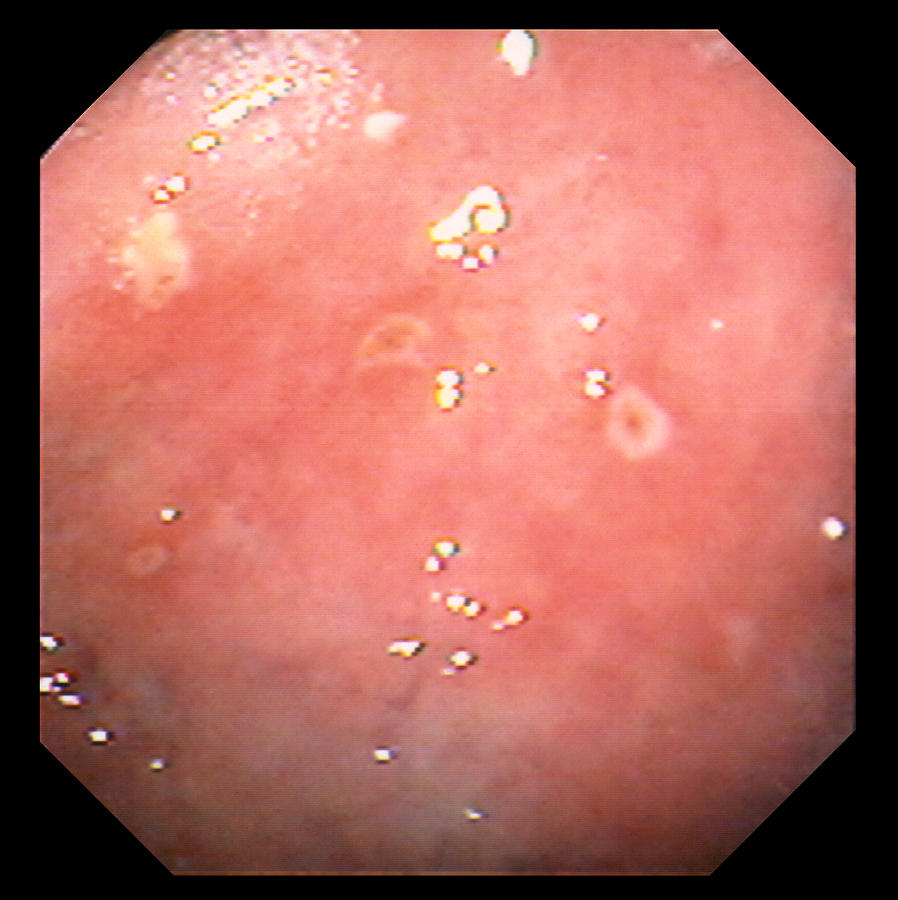 Erosive Gastritis Photograph - Erosive Gastritis by David M. Martin, Md