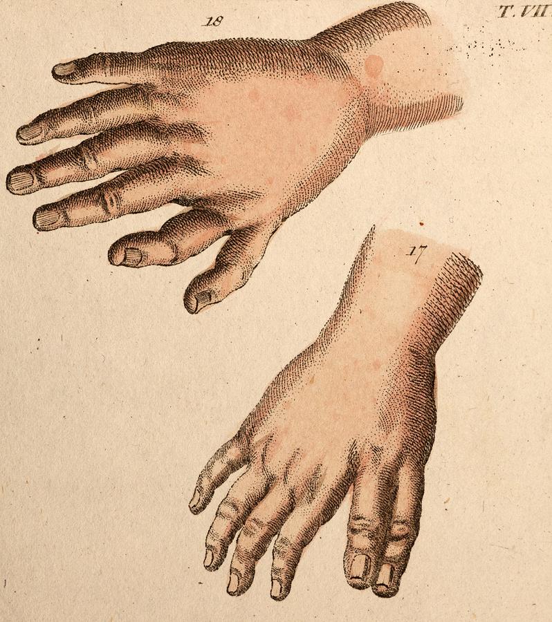 18th Century Photograph - Extra Fingers - Polydactyly Illustration by Paul D Stewart