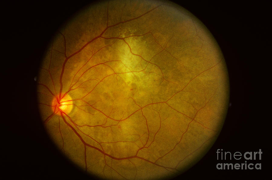 Eye Tumor Photograph by Science Source