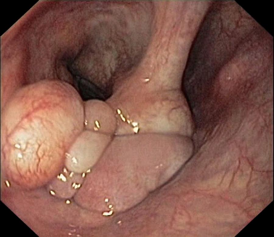 Endoscopy Photograph - Fibrolipoma In The Larynx by Gastrolab