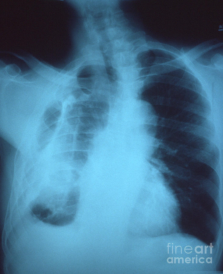 Chest Photograph - Fibrothorax by Science Source