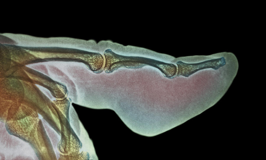 Medicine Photograph - Finger Inflammation, X-ray by Cnri