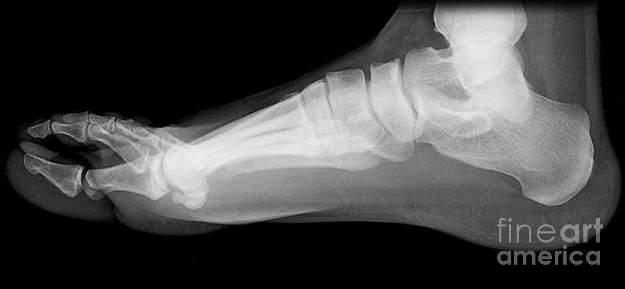 Flat Foot Photograph by Medical Body Scans