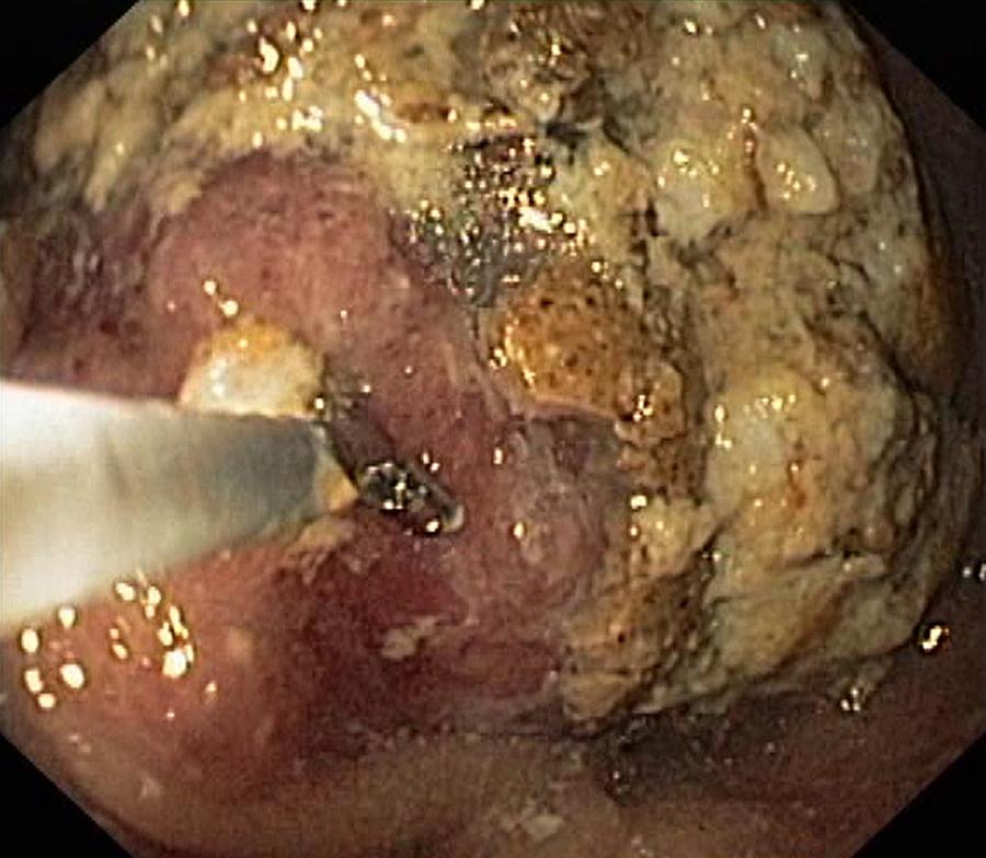Endoscope Photograph - Food Retention From Gastric Cancer by Gastrolab