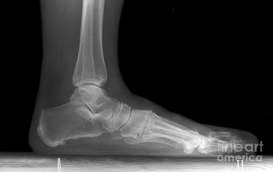 Foot X-ray Photograph by Ted Kinsman