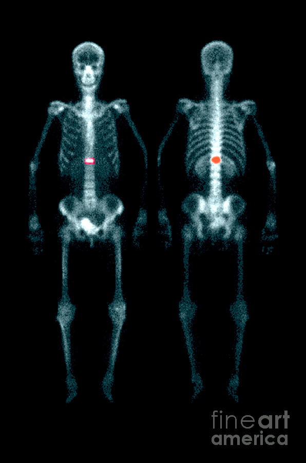Fracture Photograph by Medical Body Scans