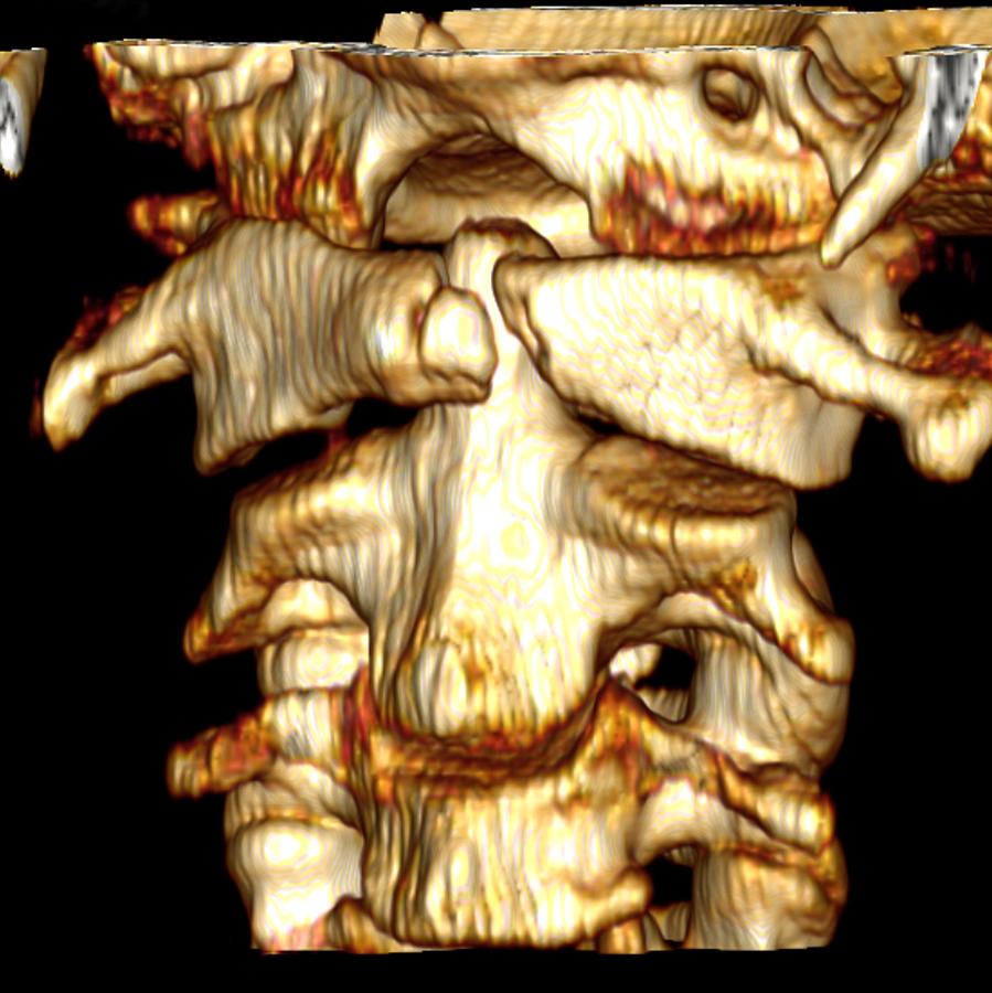Fractured Atlas Vertebra 3d Ct Scan Photograph By Du Cane Medical Imaging Ltd Fine Art America 3980