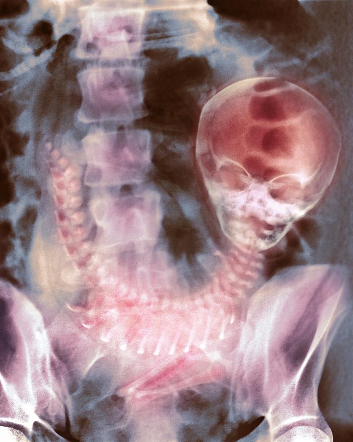 Skull Photograph - Full-term Foetus, X-ray by David Parker
