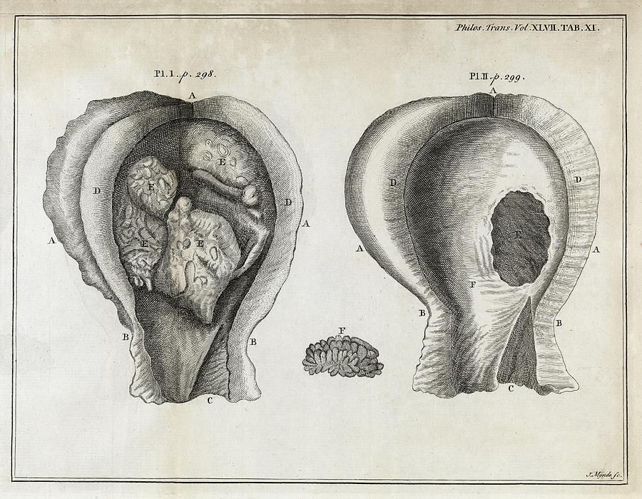 fungal-bladder-infection-18th-century-photograph-by-middle-temple