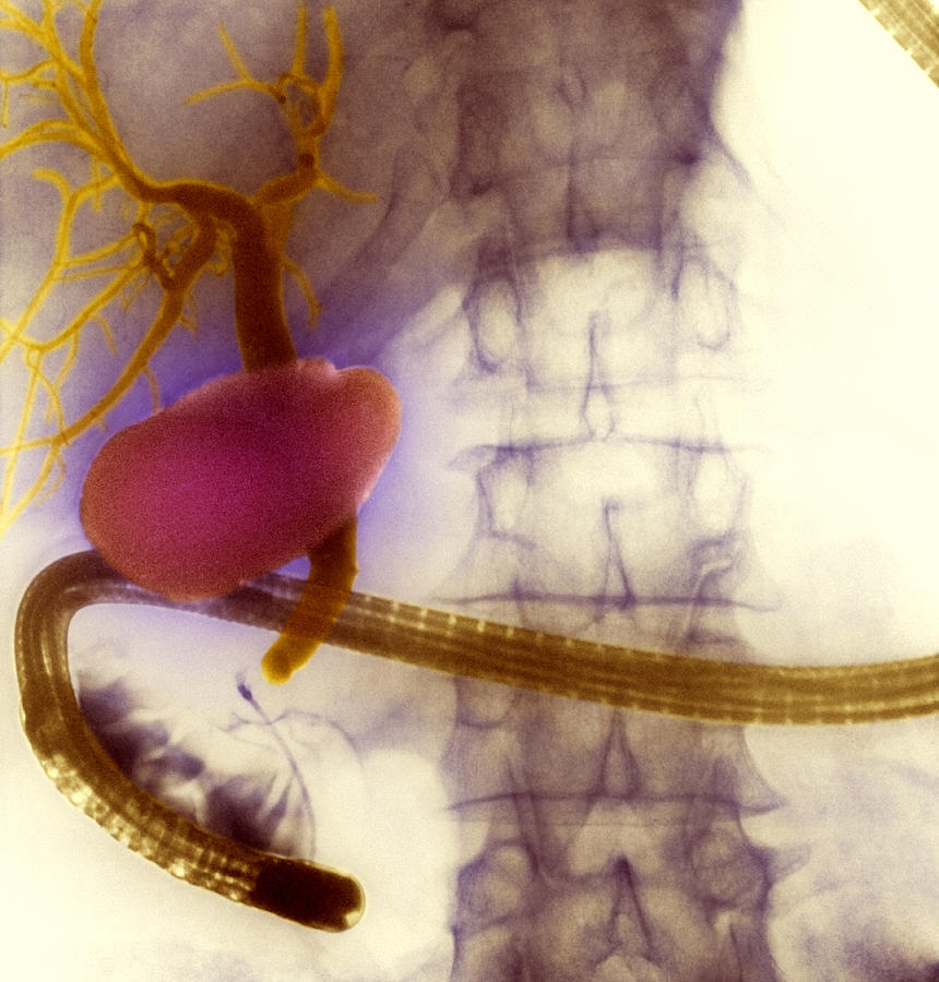 Gall Bladder And Bile Ducts, X-ray Photograph by Cnri