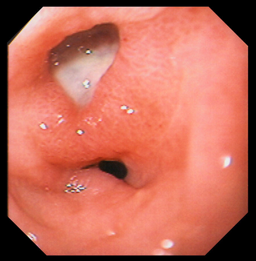 Gastric Ulcer Photograph - Gastric Ulcer by David M. Martin, Md