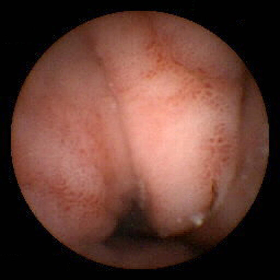 Gastritis Photograph - Gastritis, Pill Camera View by David M. Martin, Md