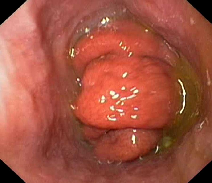 Endoscopy Photograph - Gastro-oesophageal Prolapse by Gastrolab