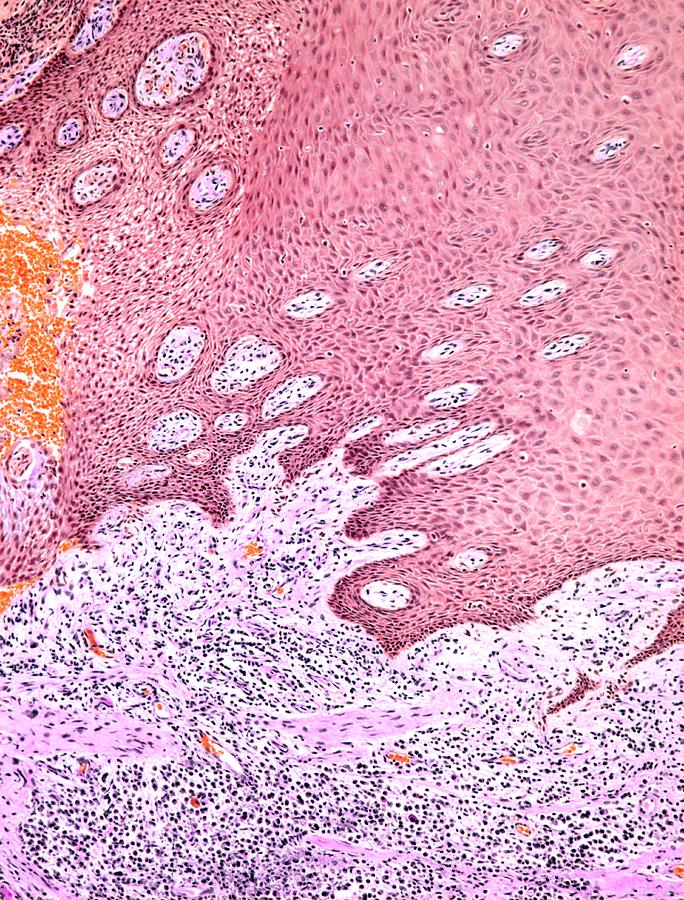 Gingivitis, Light Micrograph Photograph by Steve Gschmeissner