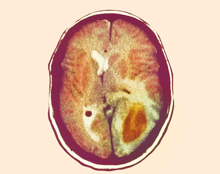 glioma-brain-cancer-ct-scan-photograph-by