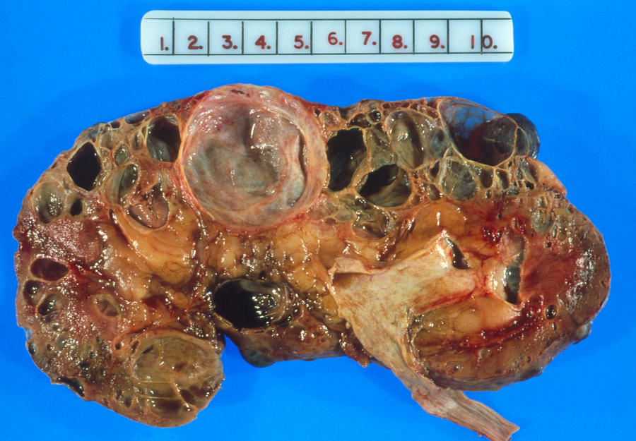Kidney Photograph - Gross Specimen: Polycystic Disease Of A Kidney by Dr. E. Walker