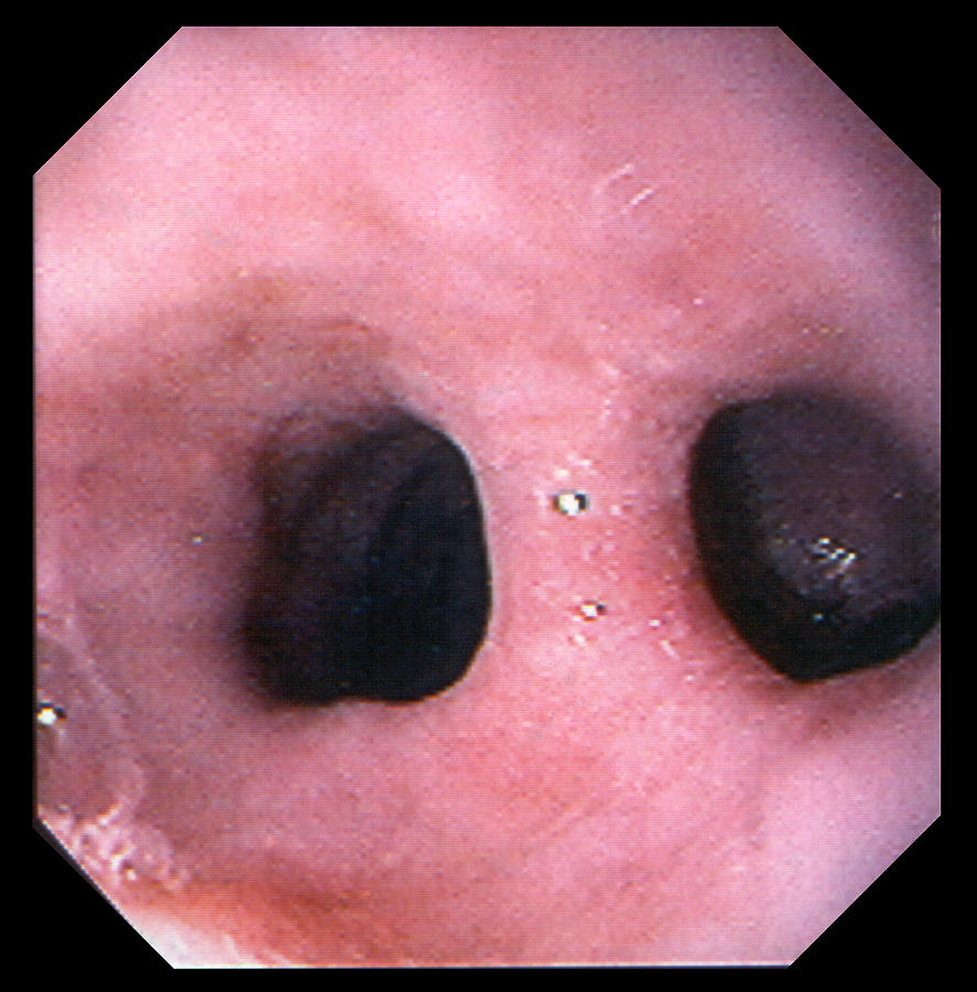 Endoscopy Photograph - Gullet Pouch by David M. Martin, Md