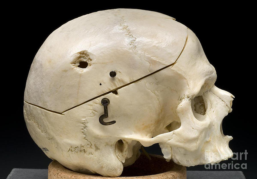 Gunshot Trauma To Skull, 1950s Photograph by Science Source