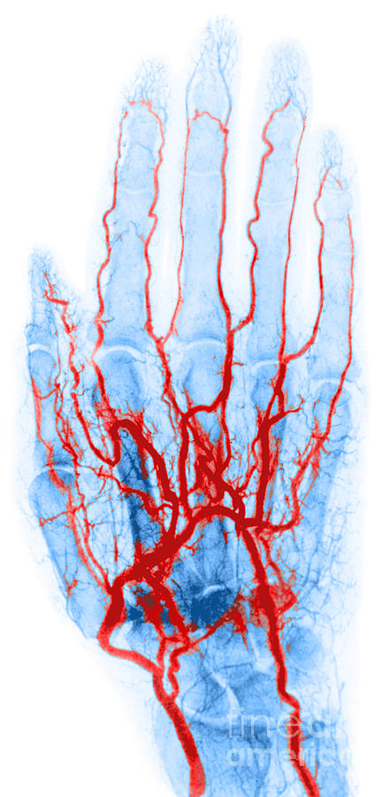 Hand Arteriogram Photograph by Science Source