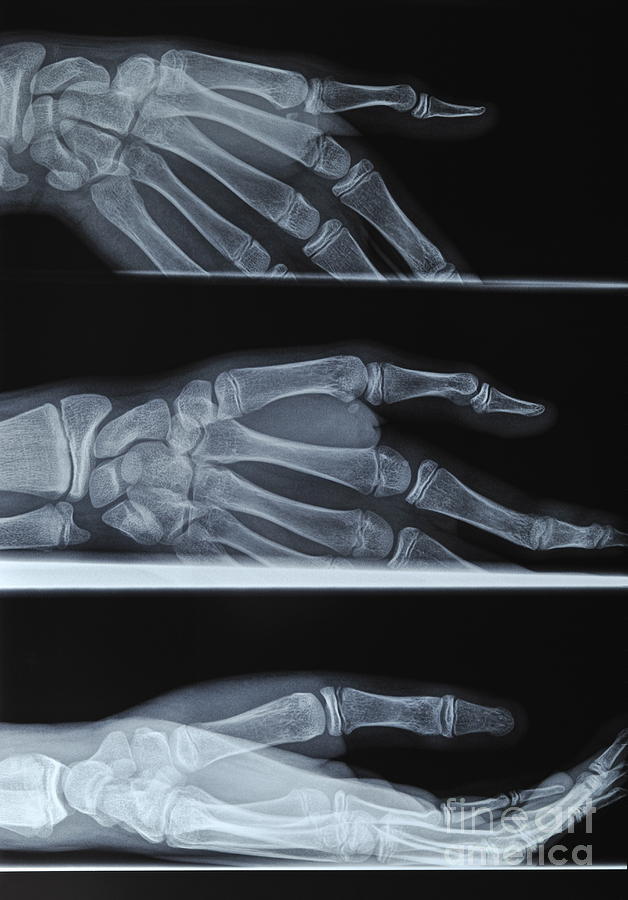Broken Photograph - Hand X-ray by Sami Sarkis