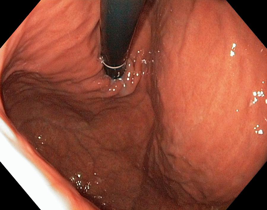Endoscopy Photograph - Healthy Fundus Of The Stomach by Gastrolab