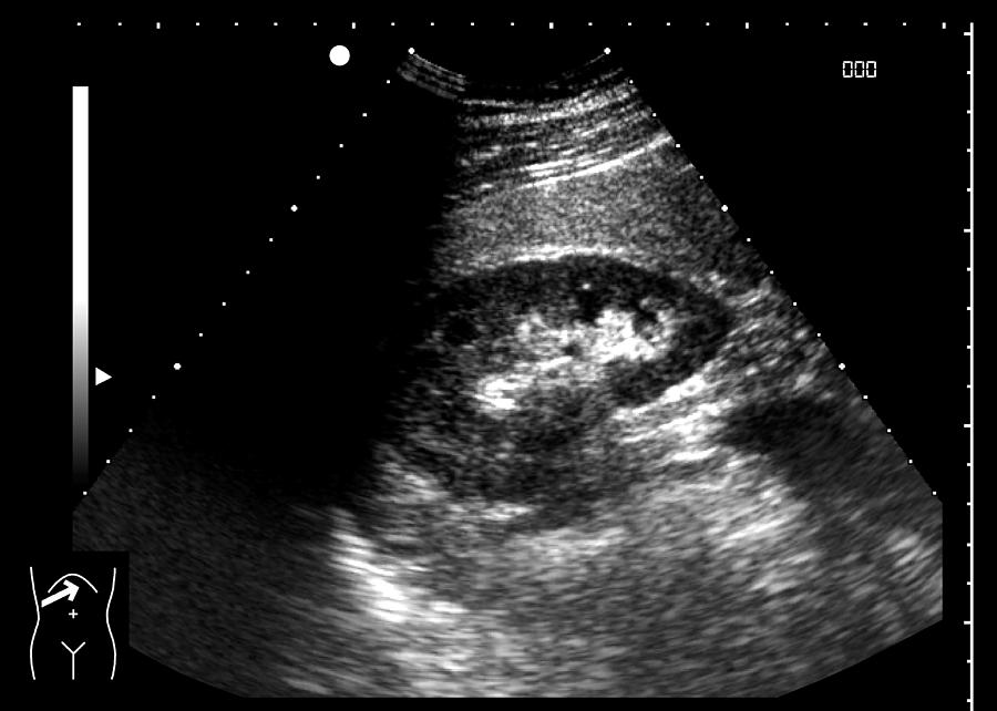 renal sonogram renal sonogram