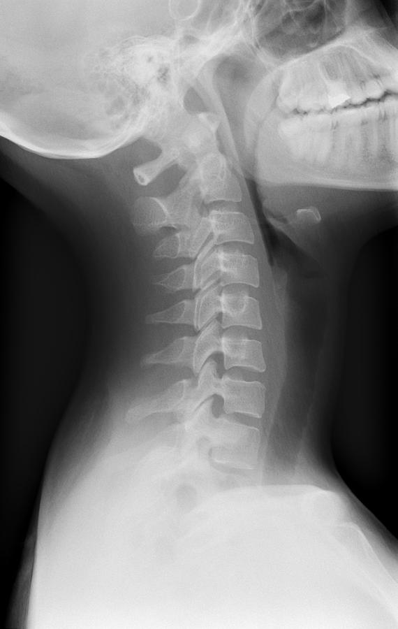 'healthy Spine Of The Neck, X-ray' Photograph by Du Cane Medical ...