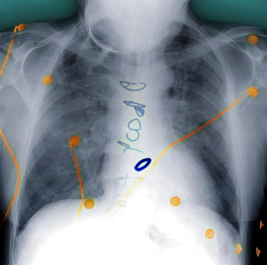 Heart Surgery, X-ray Photograph by Du Cane Medical Imaging Ltd - Fine ...