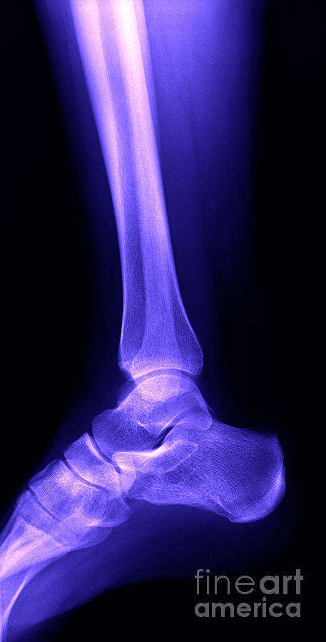 Heel X-ray Photograph by Ted Kinsman