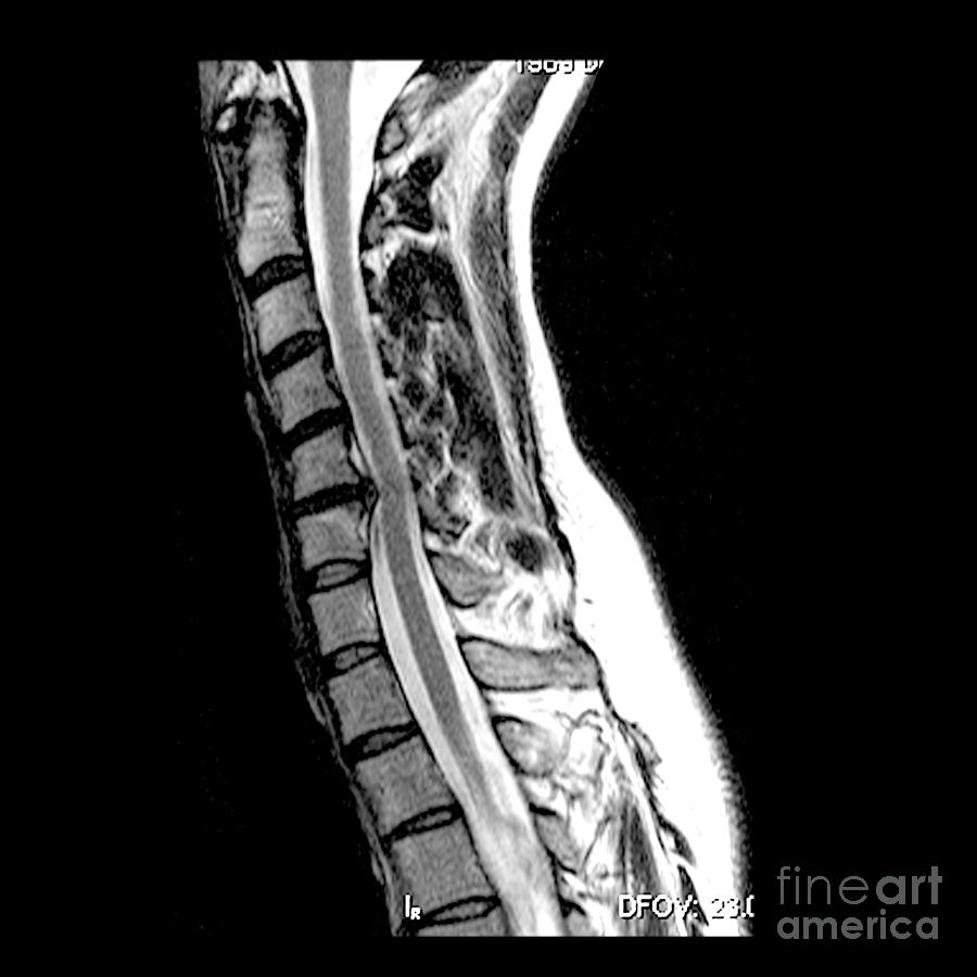 Herniated Disc In Cervical Spine Photograph by Medical Body Scans