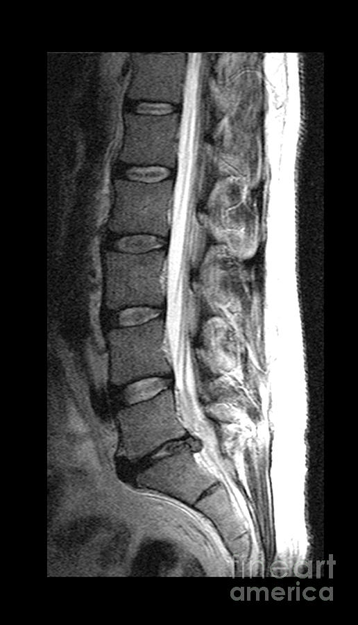 Herniated Disc Photograph by Medical Body Scans