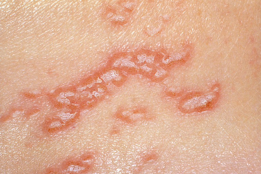 Herpes Simplex Lesions Alex Bartel 