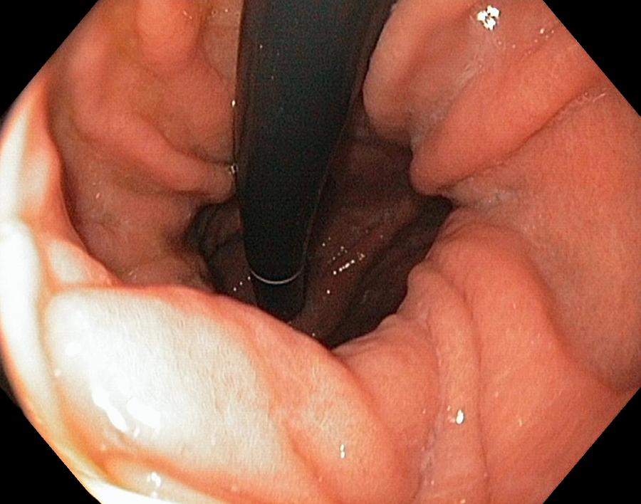 Endoscopy Photograph - Hiatus Hernia Of The Stomach by Gastrolab