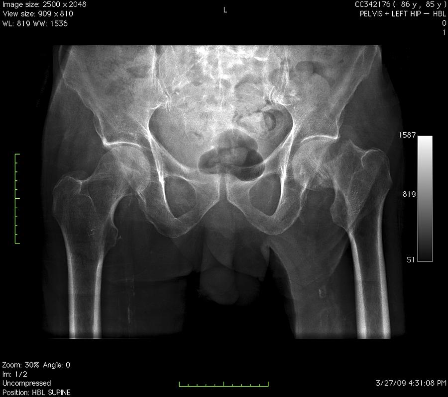 Disorder Photograph - Hip Fracture, Digital X-ray by Du Cane Medical Imaging Ltd