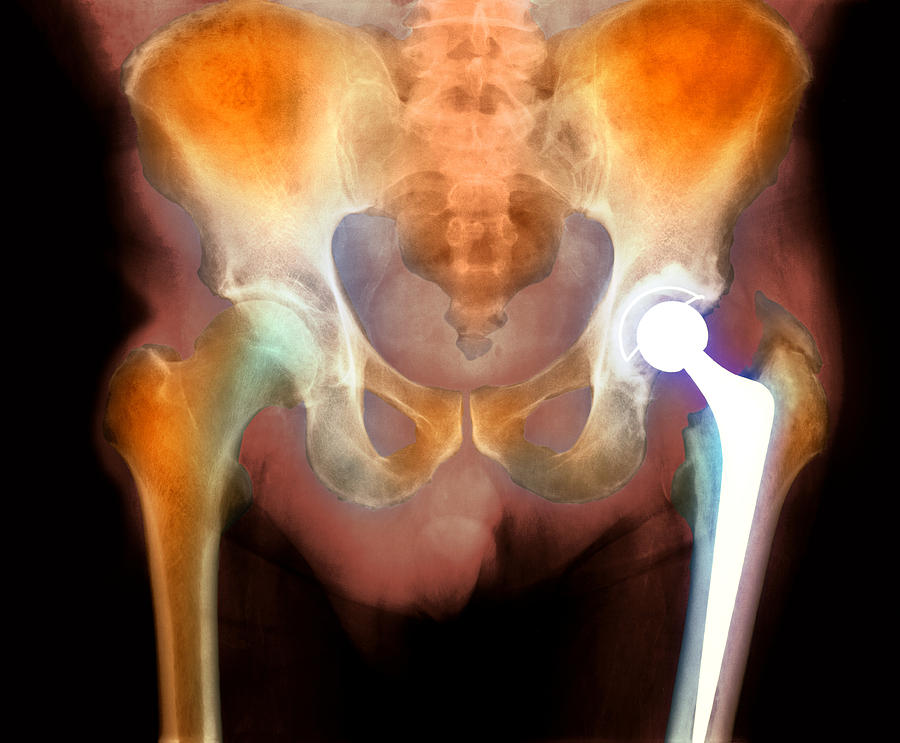 Hip Joint Replacement Photograph - Hip Joint Replacement, X-ray by 